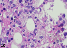 Bone marrow biopsy showing histiocytes containing intracellular yeasts