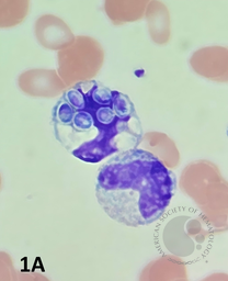 Peripheral blood smear showing monocyte with intracellular fungal organisms