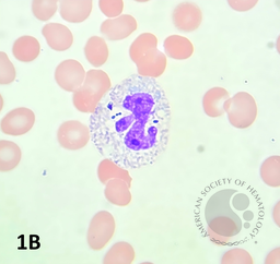 Peripheral blood smear showing neutrophil with intracellular fungal organisms