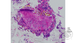 H&E Staining Sulfur granule