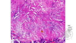 H&E Staining Sulfur granule 500x