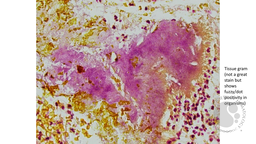 Tissue gram stain shows fuzzy/dot positivity in Actinomyces