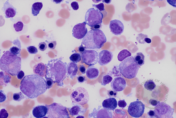 Myeloid and erythroid vacuolation in acquired copper deficiency secondary to zinc supplementation and jejunostomy feeds 2