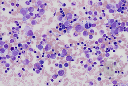 Myeloid and erythroid vacuolation in acquired copper deficiency secondary to zinc supplementation and jejunostomy feeds 3