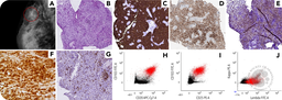 Breast hairy cell leukemia mimicking lobular breast carcinoma
