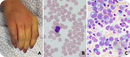 Metamizole-induced agranulocytosis resulting in ecthyma gangrenosum after an AI chatbot query