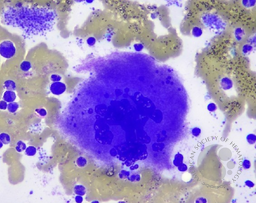 Staghorn Megakaryocyte On Bone Marrow Aspirate