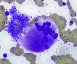 Staghorn Megakaryocyte On Bone Marrow Aspirate