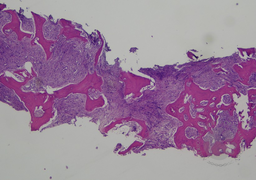 Bone trephine In Myelofibrosis