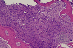 Bone trephine In Myelofibrosis
