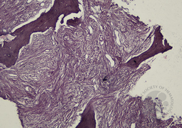 Reticulin Grading 3 In Myelofibrosis