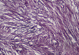 Reticulin Grading 3 In Myelofibrosis