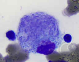 Morphology Of Storage cell In Gaucher Disease.