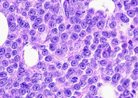High-power bone marrow biopsy showing sheets of immature erythroid precursors