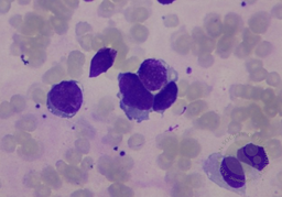 Ewing Sarcoma Cell on bone marrow aspirate