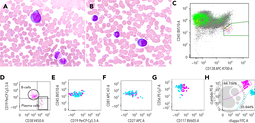 Transient aberrant plasma cells in a young patient with chronic inflammatory disease