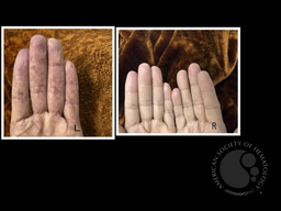 Acrocynosis with Hemolytic Anaemia