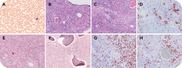 Dissecting the genetic threads underlying the fabric of pediatric myelofibrosis