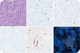 Classic Hodgkin lymphoma with IGH::CCND1 rearrangement: evidence of clonal relation to preceding mantle cell lymphoma