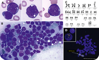 Shrouded in a starry sky: a case of AML-MRC with KMT2A amplification mimicking Burkitt-like morphology