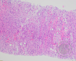 Candidiasis 1