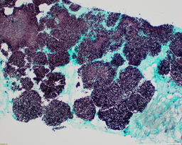 Candidiasis 2