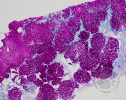 Candidiasis 3
