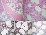 The Parvovirus in Bone Marrow